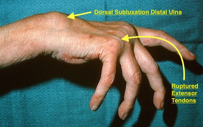 Rheumatoid Arthritis Hand Surgery Source 7325